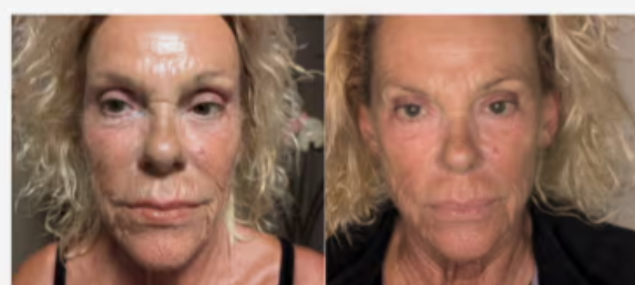 Prima e dopo EXOCELL — risultato 7