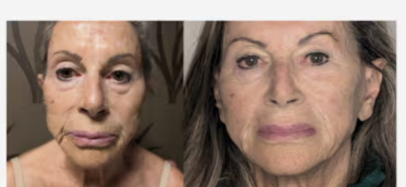 Prima e dopo EXOCELL — risultato 5